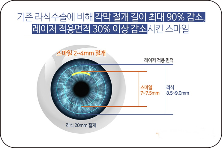 스마일 각막절개 1-1