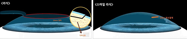 안구건조증 개선