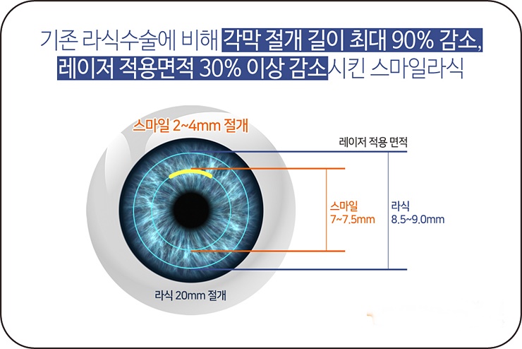 스마일 각막절개 1-1