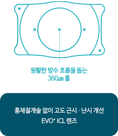 원활한 방수 흐름을 돕는 360㎛ 홀. 홍체절개술 없이 고도 근시 · 난시 개선 EVO⁺ ICL 렌즈