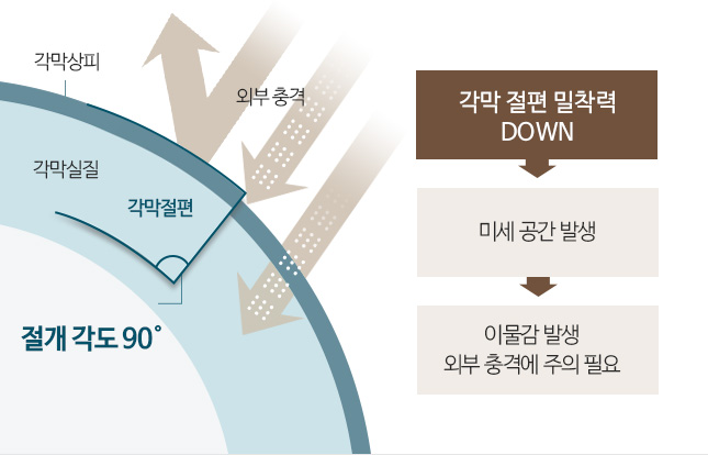 각막 절편 밀찰력 DOWN → 미세 공간 발생 → 이물감 발생 외부 충격에 주의 필요