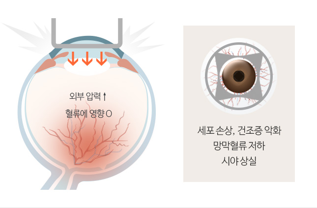 외부 압력 ↑ 혈류에 영향 O / 세포 손상, 건조증 악화, 망막혈류저화, 시야 상실