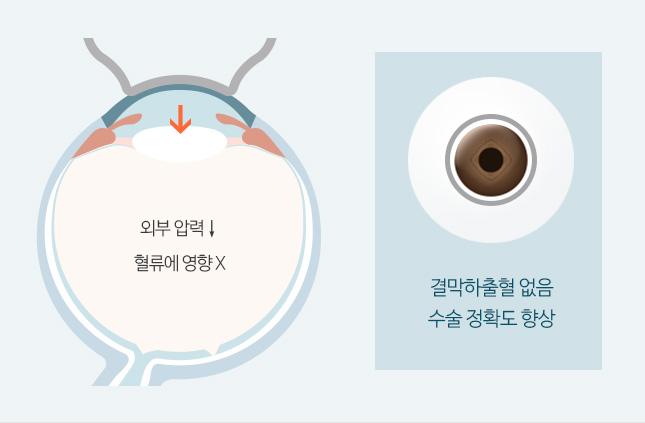 외부 압력 ↓ 혈류에 영향 X / 결막하출혈 없음, 수술 정확도 향상