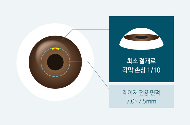 최소 절개로 각막 손상 1/10 / 레이저 전용 면적 7.0~7.5mm