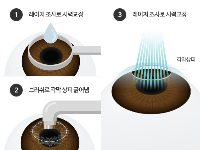 1.레이저 조사로 시력교정 / 2.브러쉬로 각막 상피 긁어냄 / 3.레이저 조사로 시력교정