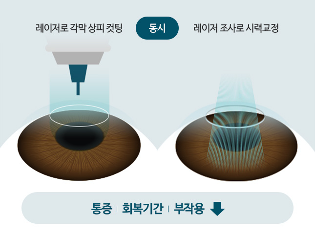 레이저로 각막 상피 컷팅 동시 레이저 조사로 시력교정. 통증 | 회복기간 | 부작용 ↓