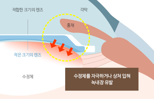 수정체를 자극하거나 상처 입혀 녹내장 유발