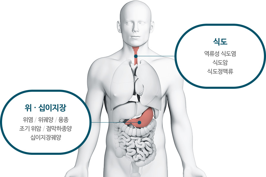 식도 : 역류성 식도염, 식도암, 식도정맥류 / 위·십이지장 : 위염, 위궤양, 용종 조기 위암, 점막하종양, 십이지장궤양