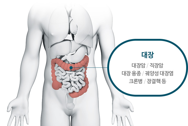 대장 : 대장암, 직장암, 대장 용종, 궤양성 대장염, 크론병, 장결핵 등